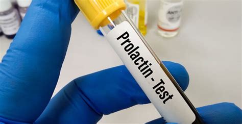 prolaktin testi kaç günde çıkar